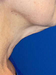 Real patient Facelift before photo